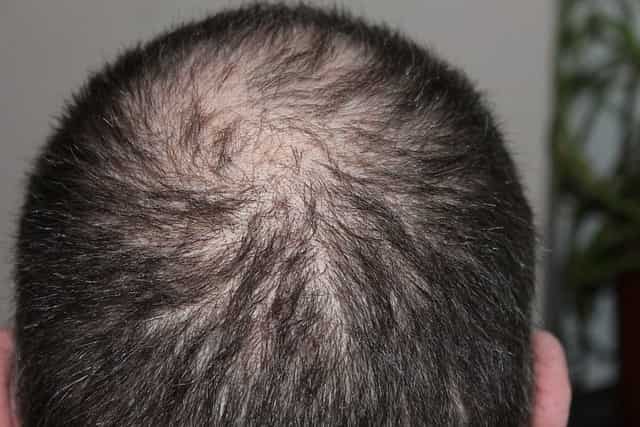 Prevents hair loss